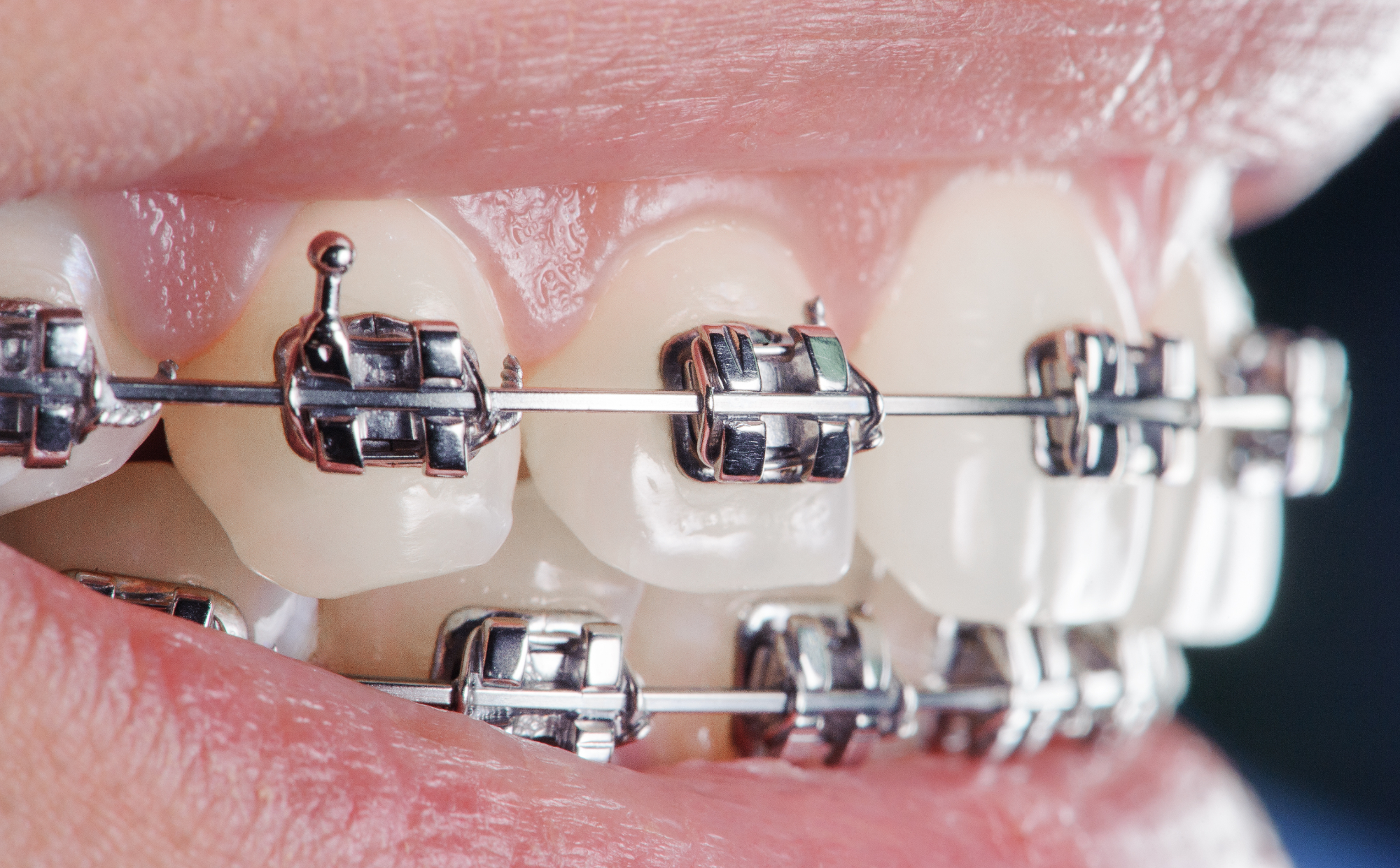 Zobni aparat je zelo pomemben za ravno rast zob